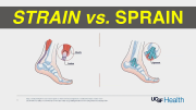 Strain vs. Sprain Treatment