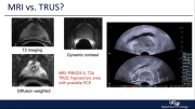 Localized Prostate Cancer Cases - Prostate Cancer Patient Conference 2022